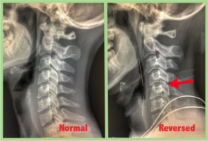 Whiplash & Neck Pain - The Key Exercises - Spinal Care Clinics